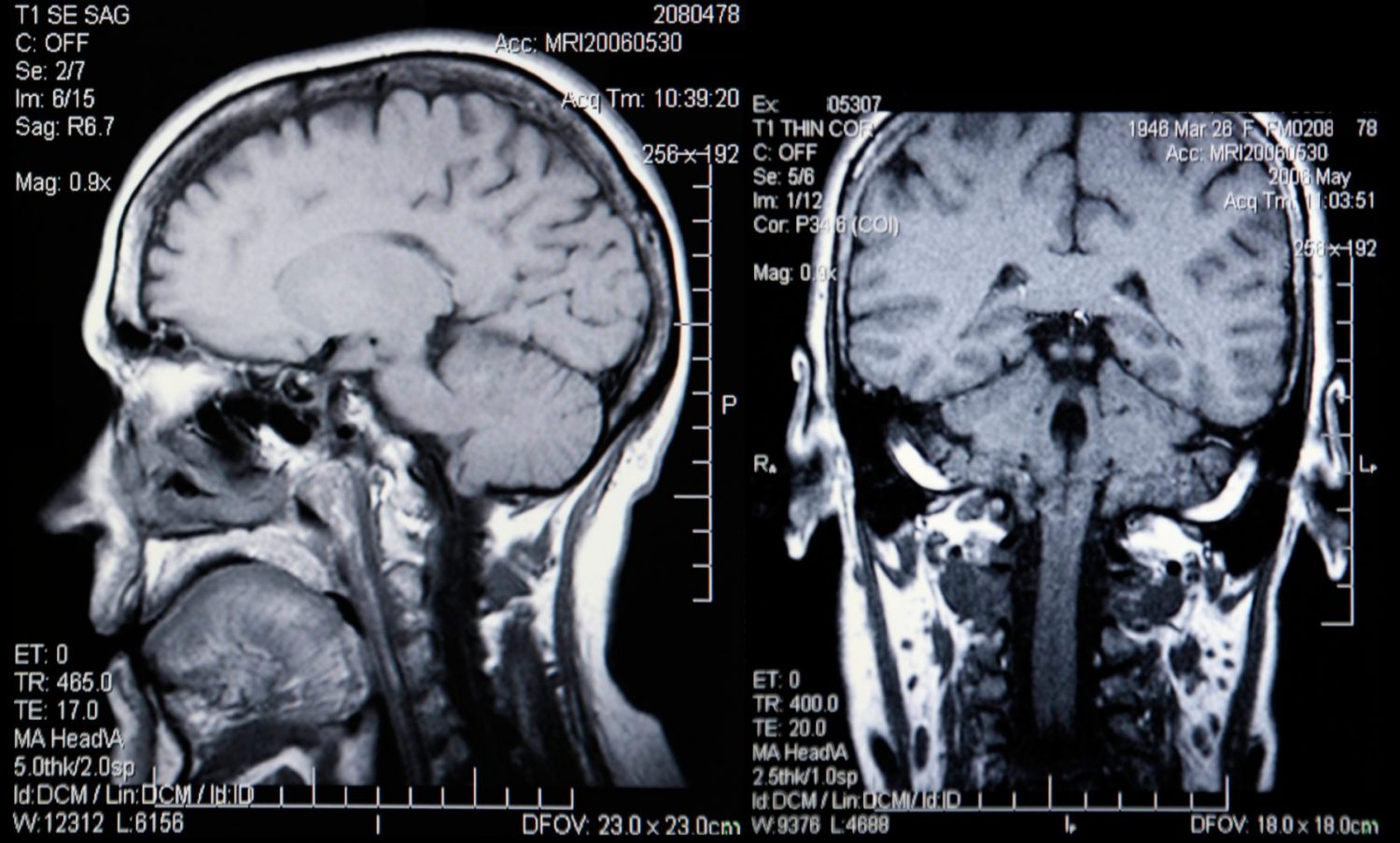 Who Are Dual Diagnosis Programs For?