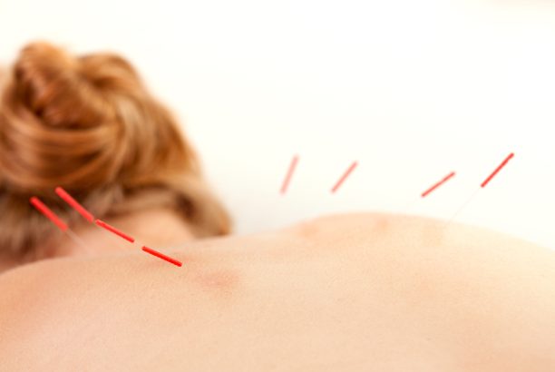 Acupuncture as a Treatment for Anxiety?