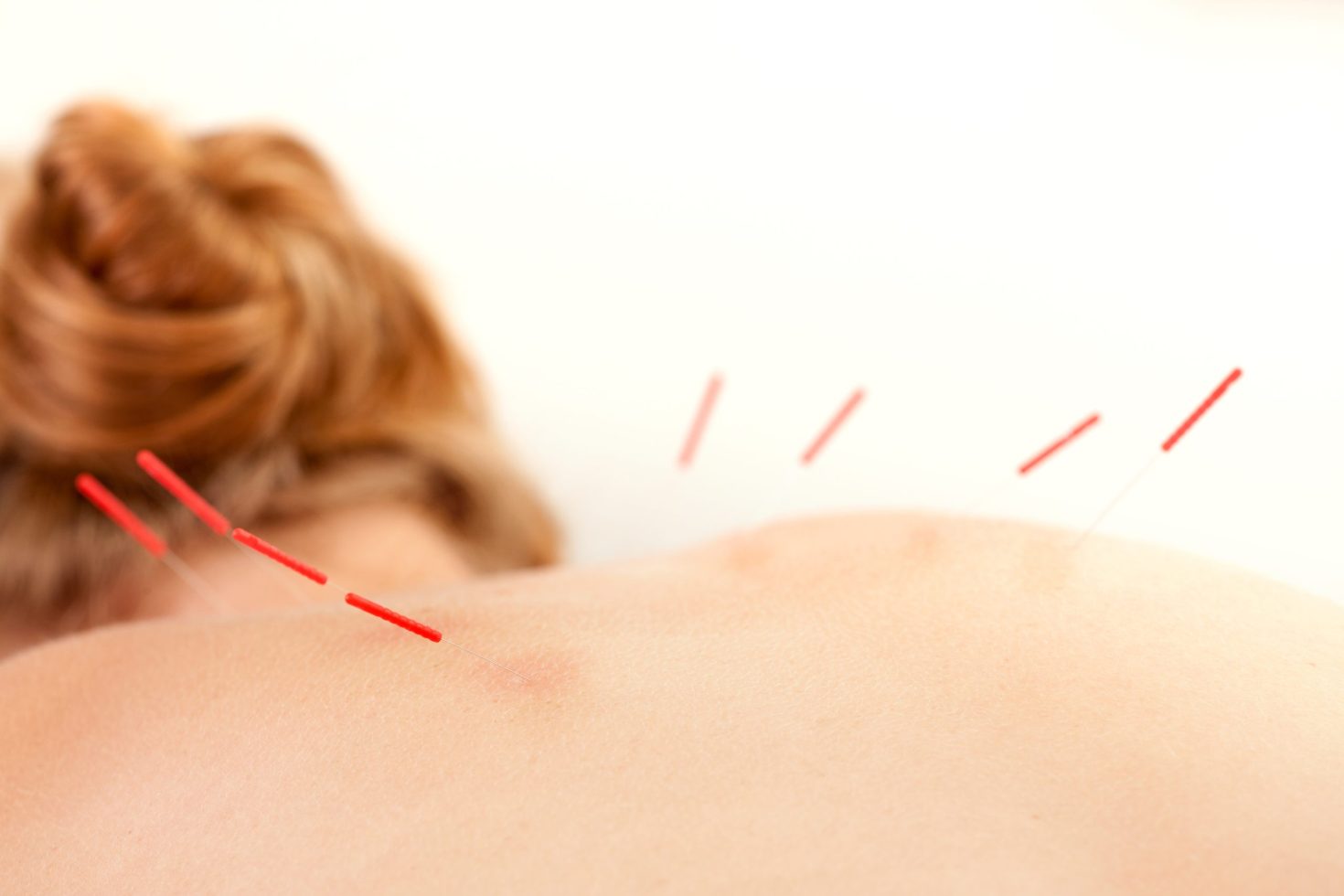 Acupuncture as a Treatment for Anxiety?