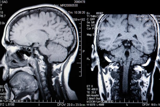 Five Tips for Living with Dual Diagnosis