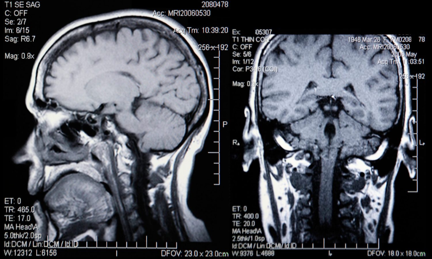 Five Tips for Living with Dual Diagnosis