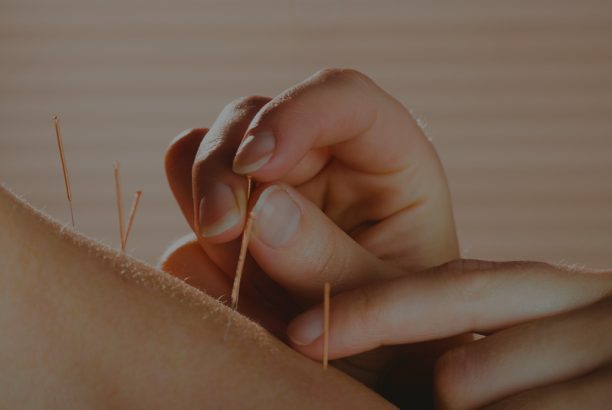 Acupuncture
