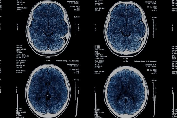 Transcranial Magnetic Stimulation (TMS)