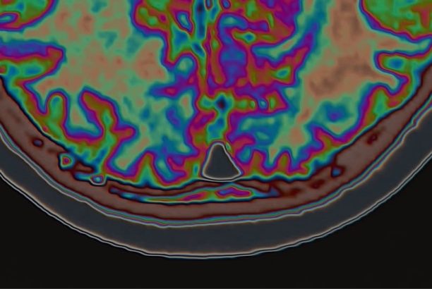 TMS Therapy For OCD