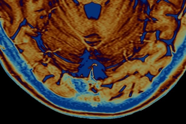 TMS For Smoking Cessation