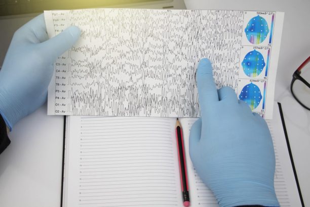 When Seizures Aren’t Epilepsy & Non Epileptic Seizures Treatment