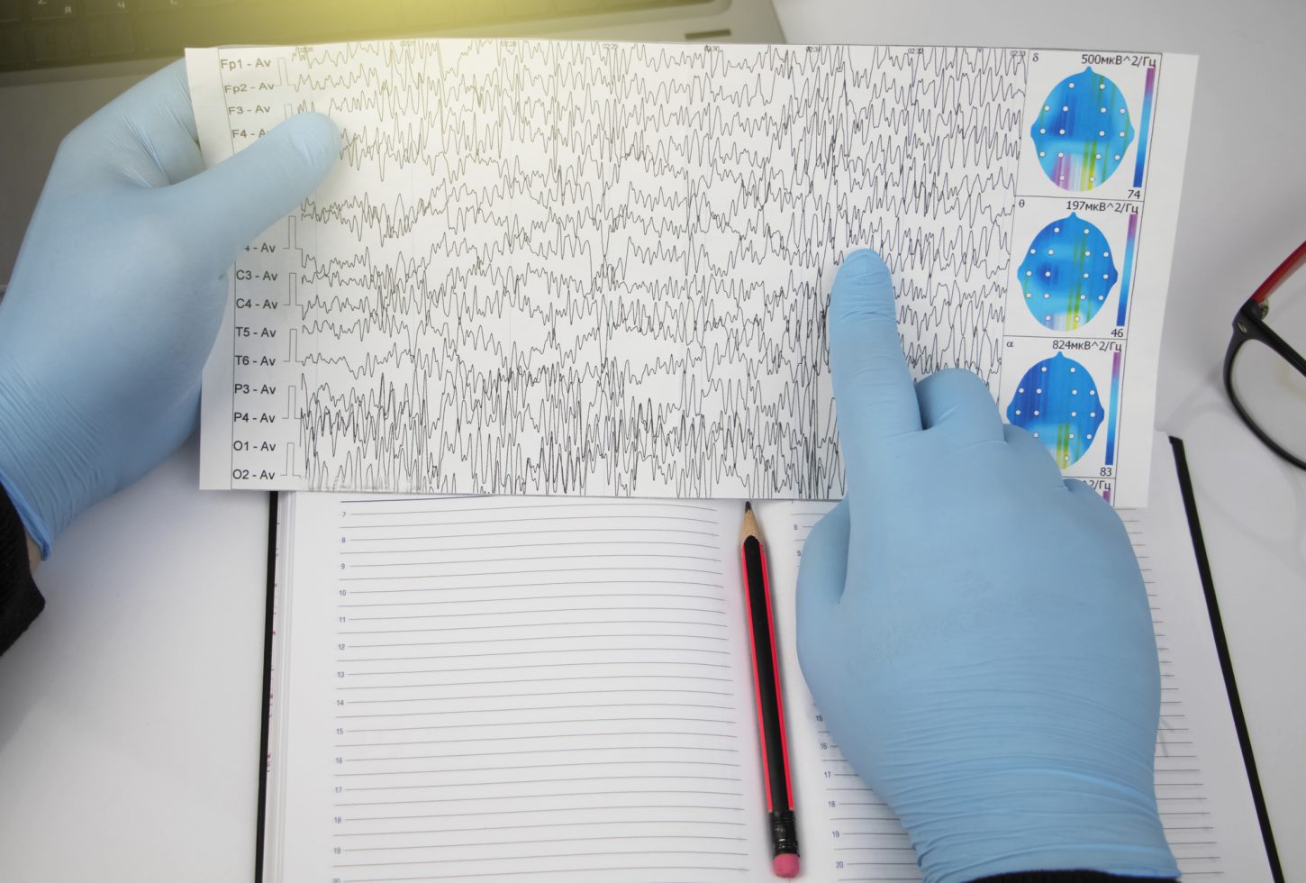 When Seizures Aren’t Epilepsy & Non Epileptic Seizures Treatment