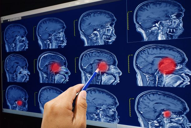 Determining if TMS Treatment for Depression is a Good Fit for You