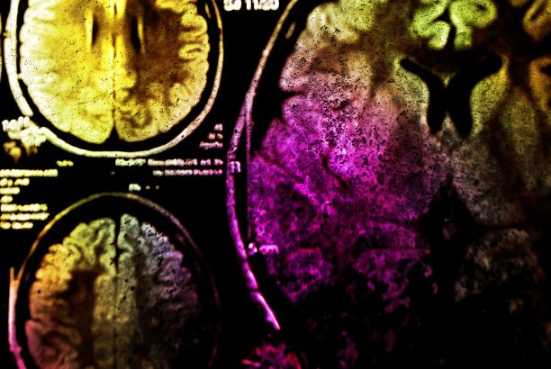 Exploring Some of the Benefits of TMS for Depression