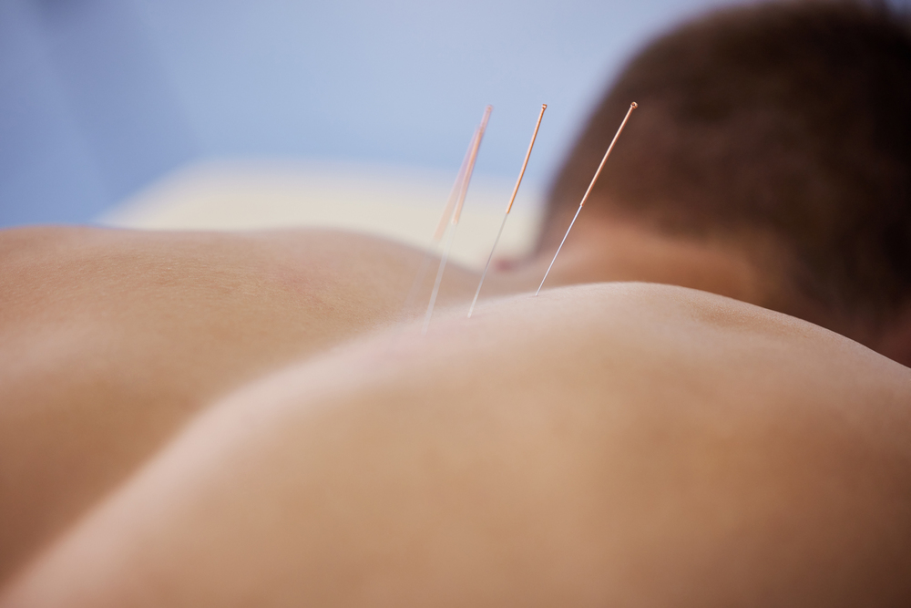 Discovering the Benefits from Acupuncture for Trauma Recovery